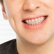 Transparent Braces: A Clear Path to a Better Smile